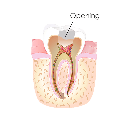 All the decays are removed and an access is made through the tooth to reach the pulp cavity and canals.