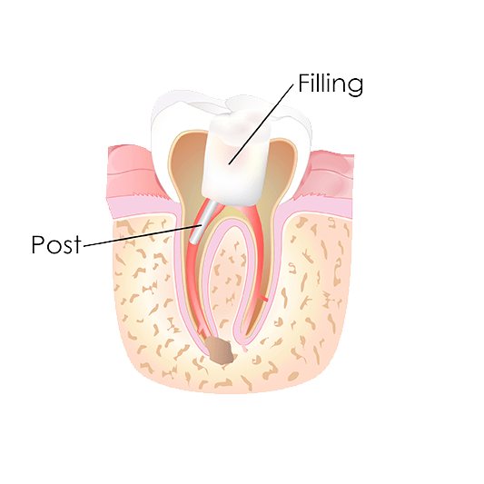 Sometimes when the infection is more, medication is kept inside of the tooth.
