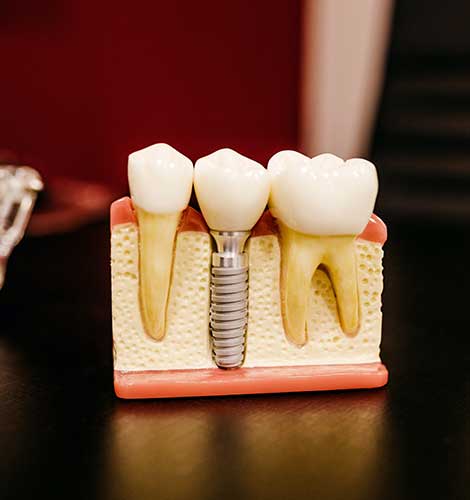 dental implant in kolkata