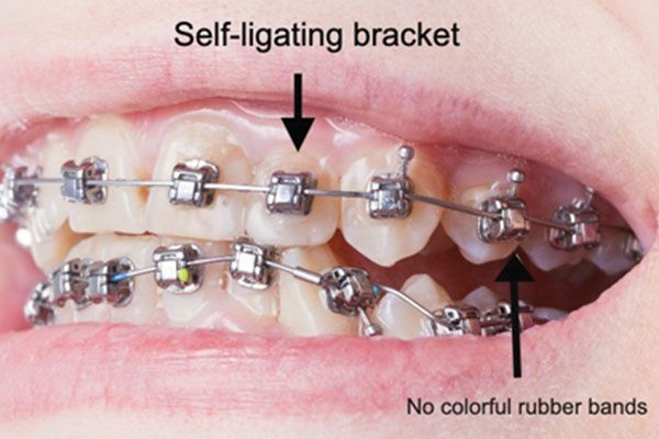 self ligating braces | Dental World