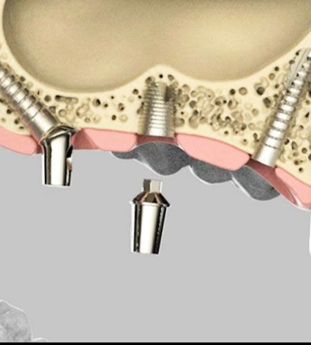 Placing the Dental Implant